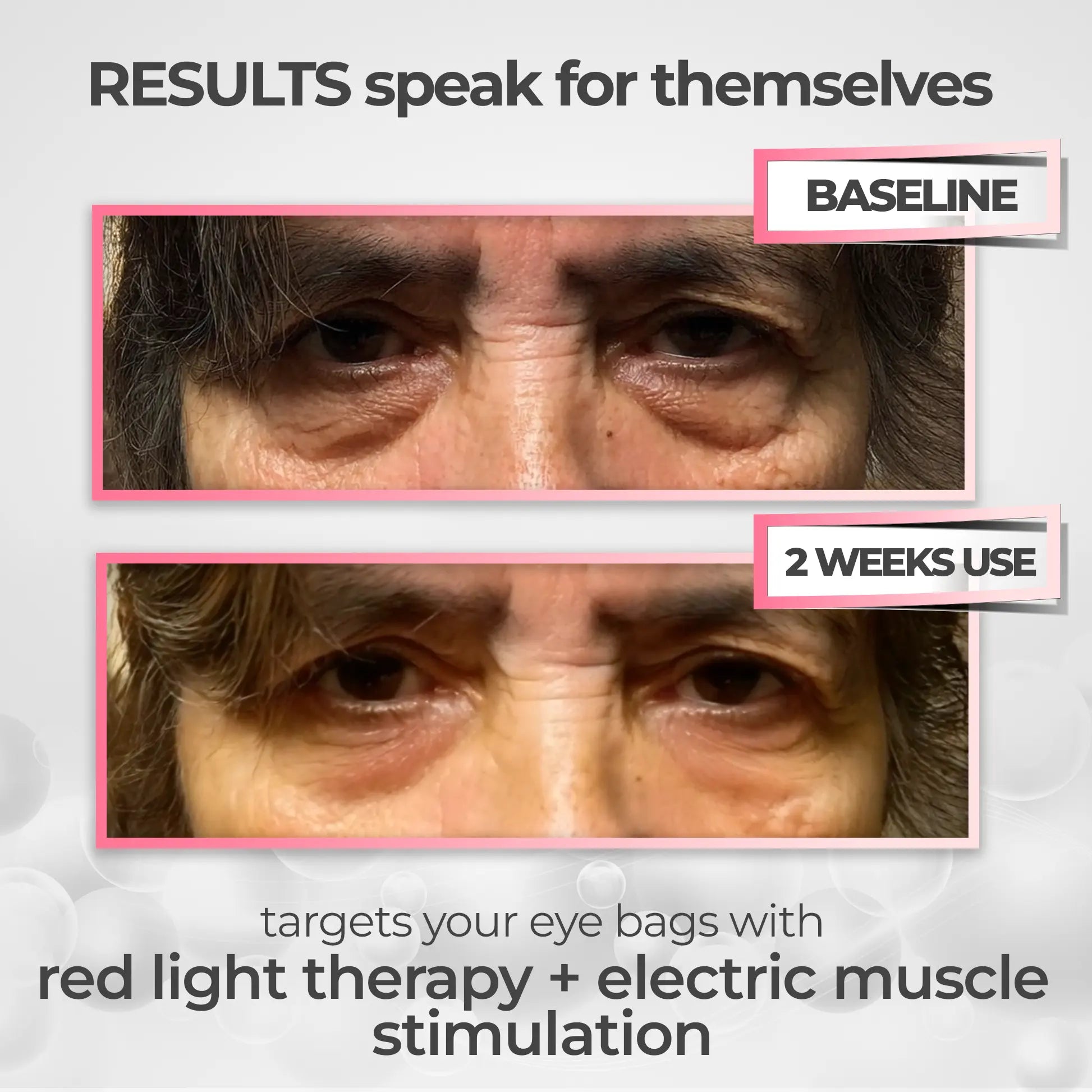 2-in-1 Red Light Therapy + EMS To Erase Eye Bags by GleamiqueCare