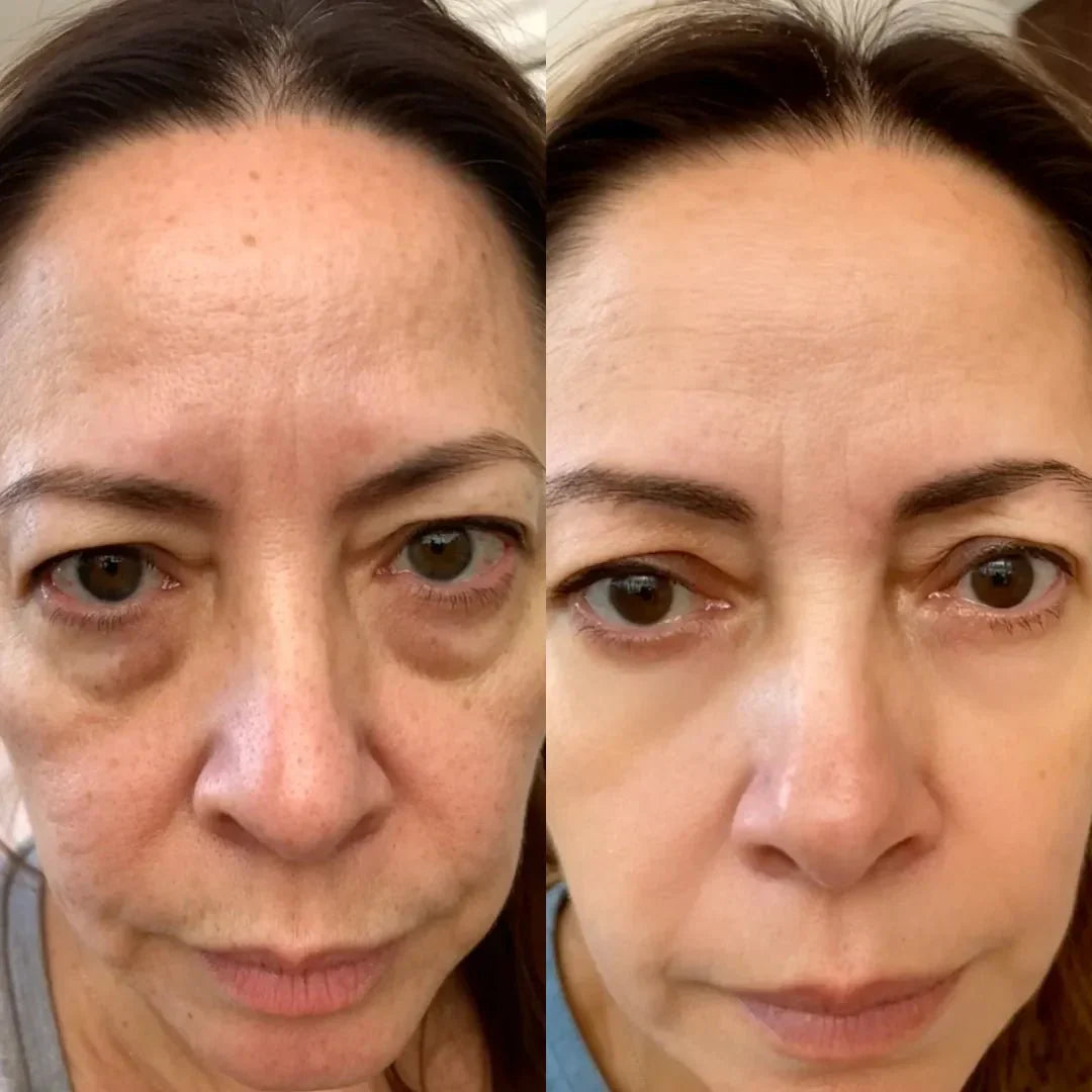 2-in-1 Red Light Therapy + EMS To Erase Eye Bags by GleamiqueCare